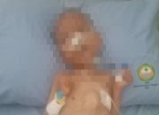 Bikin Sesak Dada, Bocah Gizi Buruk di Parungpanjang Meninggal, Tak Terdaftar di BPJS PBI 